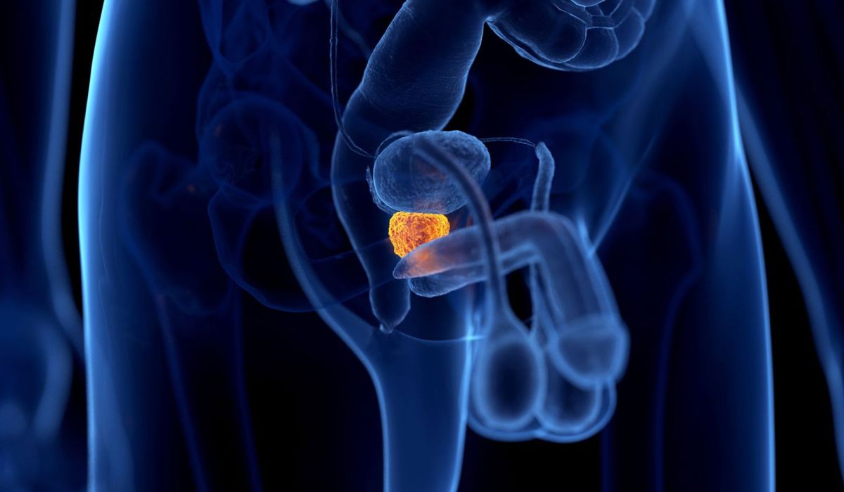 Prostatabeschwerden &ndash; Muss es soweit kommen?